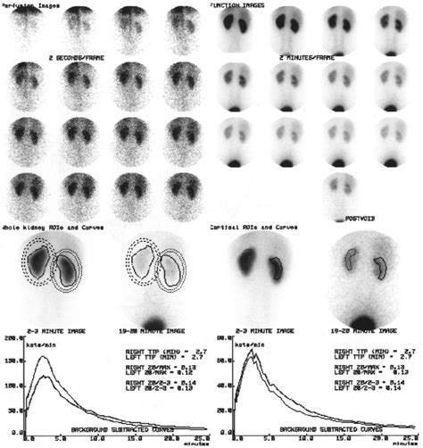 MAG3 renogram in an individual with normal kidneys. As well as showing... | Download Scientific ...