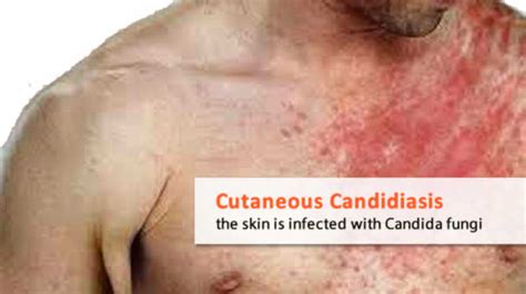 Cutaneous-candidiasis-candida-skin-rash | Candida Cure Center