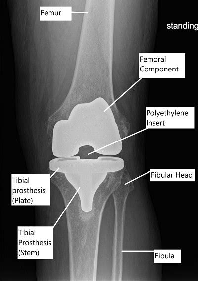 Total Knee Replacement Recovery Guide | Complete Orthopedics | Multiple NY Locations