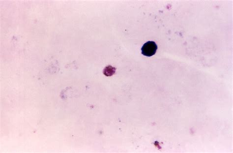 Plasmodium Malariae Under Microscope