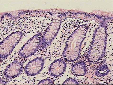 Celiac Disease in Course of Lymphocytic Colitis in Children