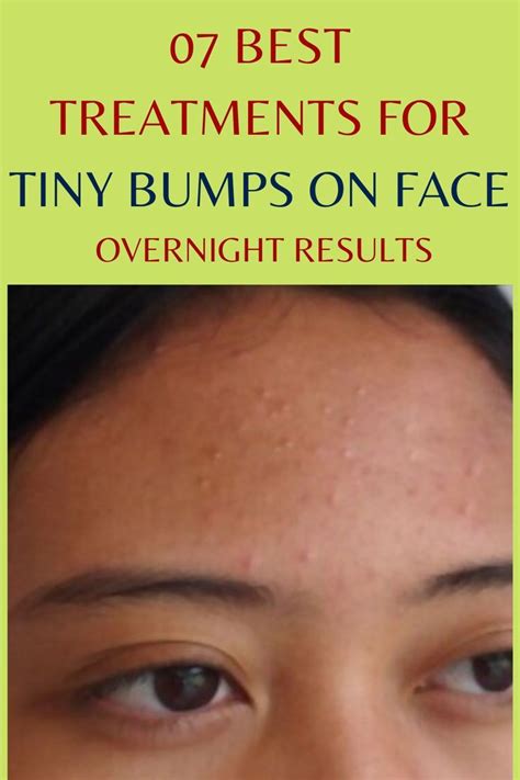 07 Best Treatments For Tiny Bumps On Face - Overnight Results White Bumps On Face, Small Bumps ...