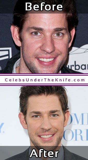 John Krasinski Nose Job? - Before & After Plastic Surgery