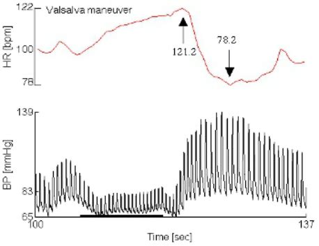 Valsalva ratio is defined as the maximum heart rate during the maneuver ...