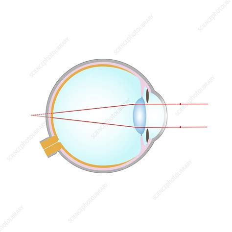 Long sightedness, illustration - Stock Image - C047/5815 - Science Photo Library