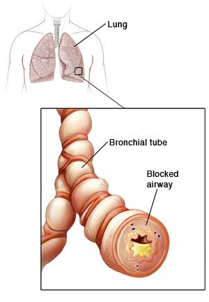 Acute Bronchitis | Saint Luke's Health System