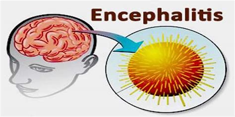 Encephalitis - Causes, Symptoms, Diagnosis, Prognosis & Treatment