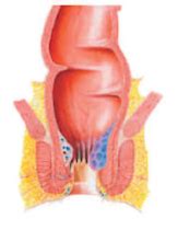 The Hemorrhoid Grading System | Hemorrhoid Grade 1, 2, 3, 4 - Hemorrhoid Treatment Options