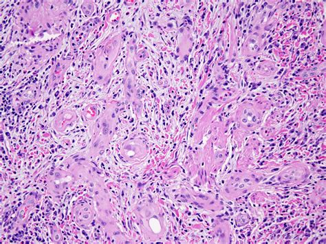 Pathology Outlines - PathologyOutlines.com