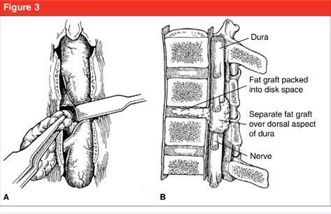 Figure 3 from Dural Tears in Spine Surgery | Semantic Scholar