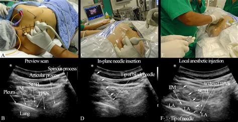 Paravertebral Block Ultrasound