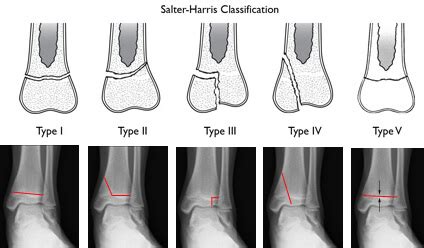 Salter Harris Classification for Physeal Fracture: Mnemonic | Epomedicine