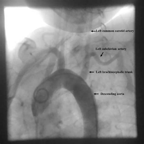 Posteroanterior projection angiogram of the ascending aorta shows the... | Download Scientific ...