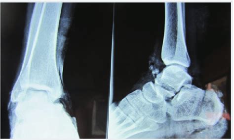 Fracture talus and fracture calcaneus. | Download Scientific Diagram