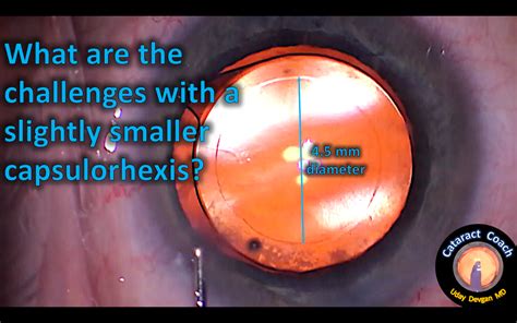 Challenges with a smaller capsulorhexis – Cataract Coach