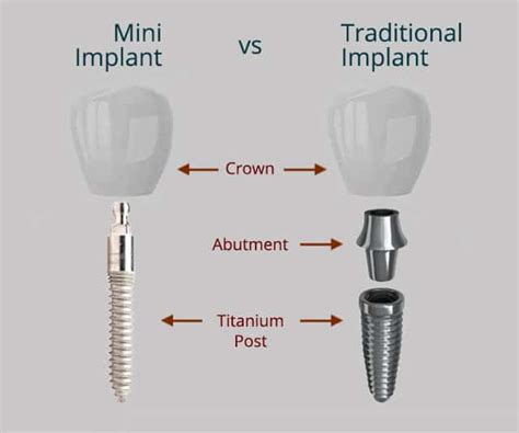 Best Midtown NYC Mini Dental Implants near you | Treating Missing Teeth ...