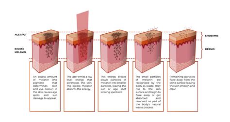 What Is The Approach To Melasma Treatment? - Ensoul Medical Clinic