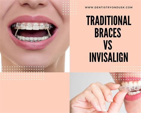 Braces vs Invisalign: Which Is Better