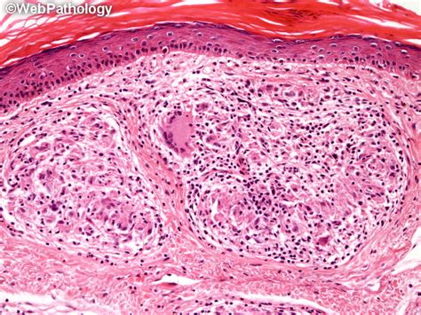 Webpathology.com: A Collection of Surgical Pathology Images