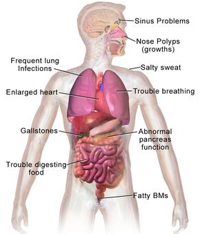 Cystic fibrosis - Wikipedia