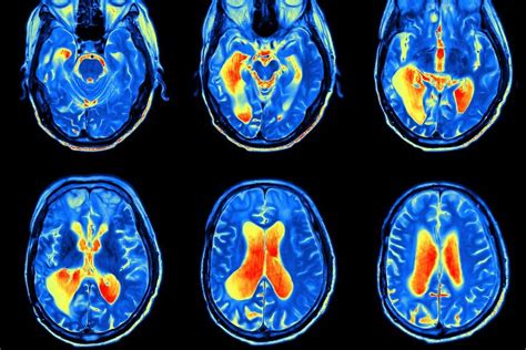 How Does TMS relieve Depression? — Paradigm Psychiatry