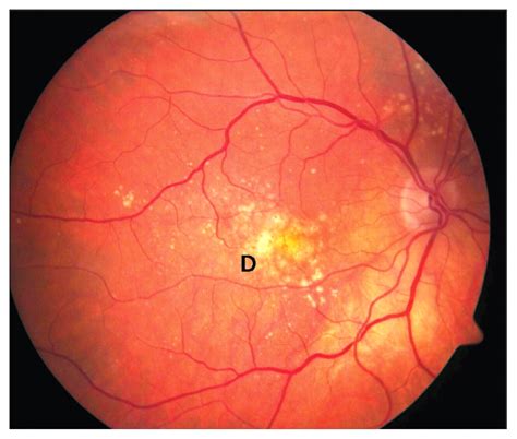 Age-related macular degeneration | CMAJ