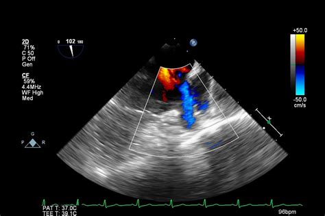 Transesophageal Echocardiogram (TEE) Specialist in Naples, FL | Naples Cardiac & Endovascular Center