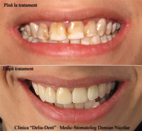 Fluorosis | Dentagama