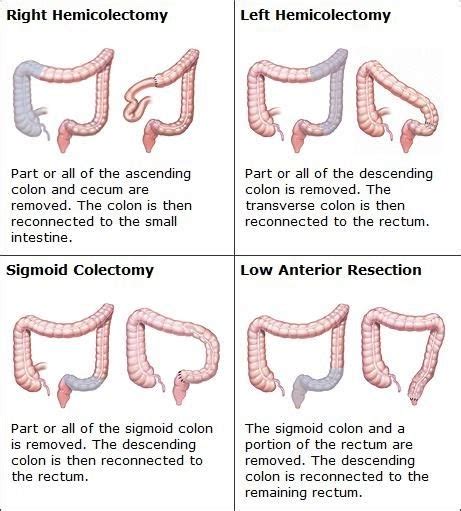 What Is A Right Hemicolectomy Surgery - Jeffrey Merriman Bruidstaart