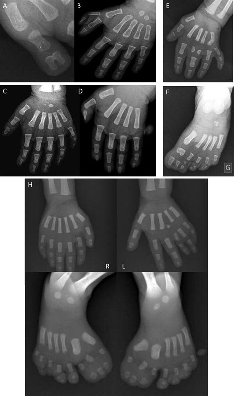 Different types of polydactyly. (A, B) Preaxial polydactylies. (C) Type... | Download Scientific ...