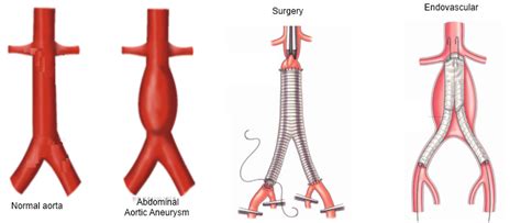 Aortic aneurysm surgery - HonorHealth