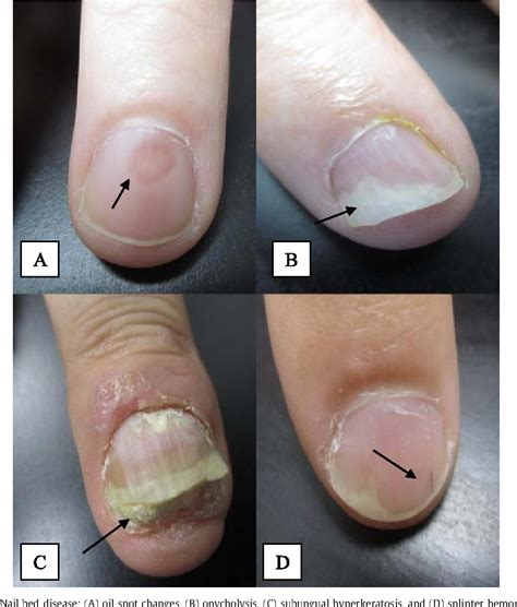 Figure 2 from Psoriatic arthritis and nail changes: exploring the ...