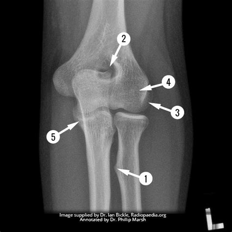 Radius Bone Labelled : Bones Teaching Resources - Anatomy standard ...