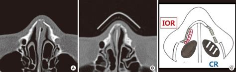 Nasal Fracture Splint