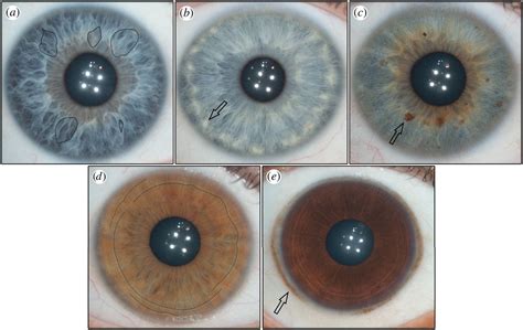 EYE COLOR CHANGE SURGERY – LASER EYE COLOR CHANGE TURKEY | VIP EYE LASER CENTER