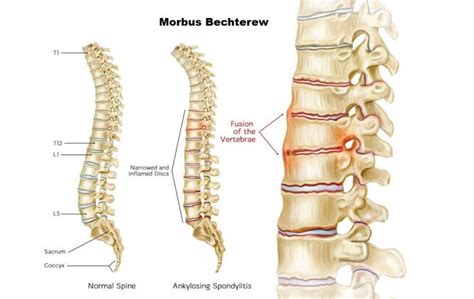 Morbus bechterew behandlung. Morbus Bechterew (Ankylosing Spondylitis ...