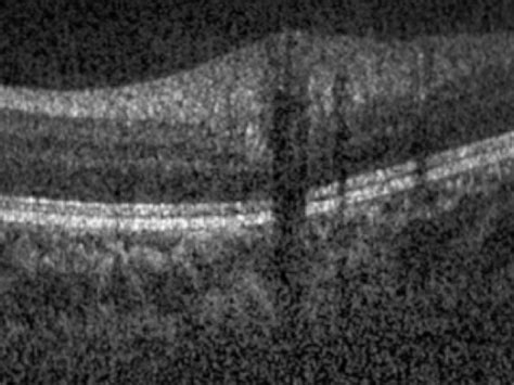 3D AI for Glaucoma