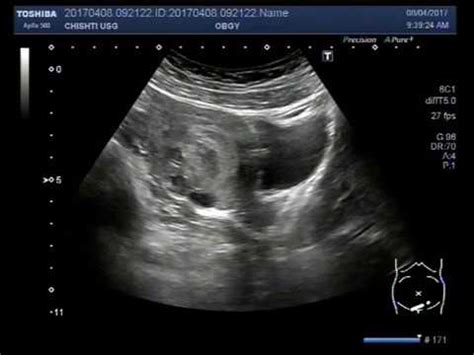 Ultrasound Video showing multiple fibroids with early pregnancy. - YouTube