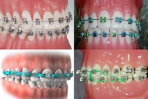 How Braces Work to Straighten Your Teeth?