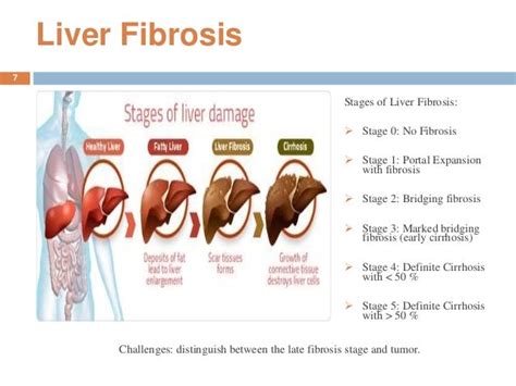 Intelligent computer aided diagnosis system for liver fibrosis