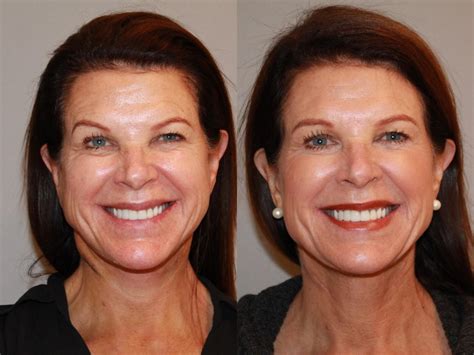 Neck Lift (Submentoplasty) Before and After Pictures Case 142 | Atlanta, Georgia | Buckhead ...