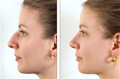 Dr. Steven Denenberg's facial plastic surgery before and afters: Rhinoplasty, large tip noses #7