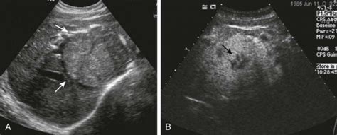 Benign Tumors of the Liver | Radiology Key