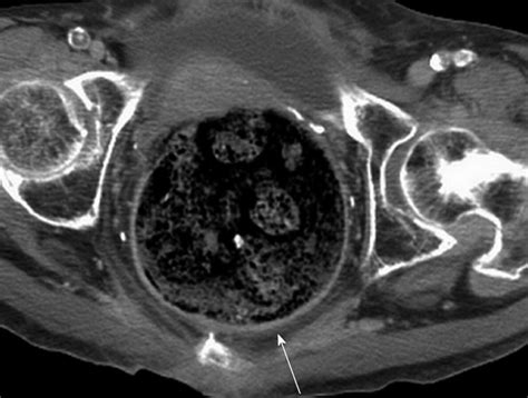 Necrotic stercoral colitis: Importance of computed tomography findings