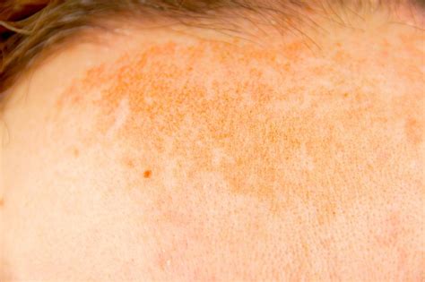 Hyperpigmentation: Treatment, types, and causes - Richmond Hill ...