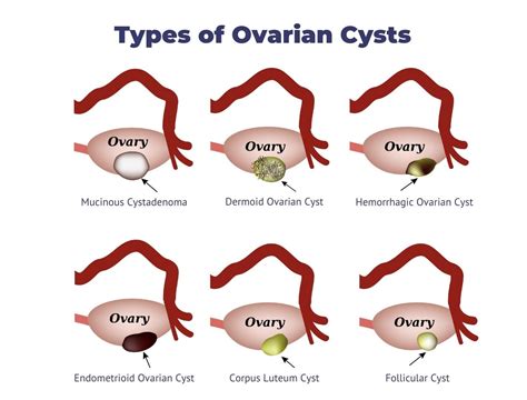 Ovarian Cyst Definition Types Symptoms Causes | The Best Porn Website