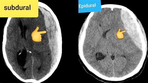 Epidural hematoma CT - YouTube