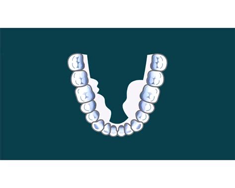 What is Mandibular Tori? What causes it? - OdontoVida