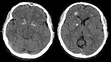 Brain computer tomography cuts of the patient with 22q11.2 syndrome, demonstrating basal ganglia ...