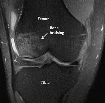 Bone Bruises - What Are They? | Ramsay Healthcare